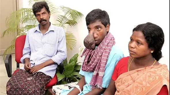 خارج کردن توموری عجیب از صورت پسر هندی+تصاویر