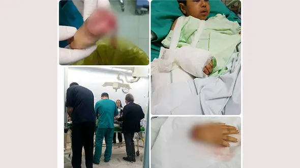 پیوند دست قطع‌شده پسر 7 ساله زلزله‌زده + عکس