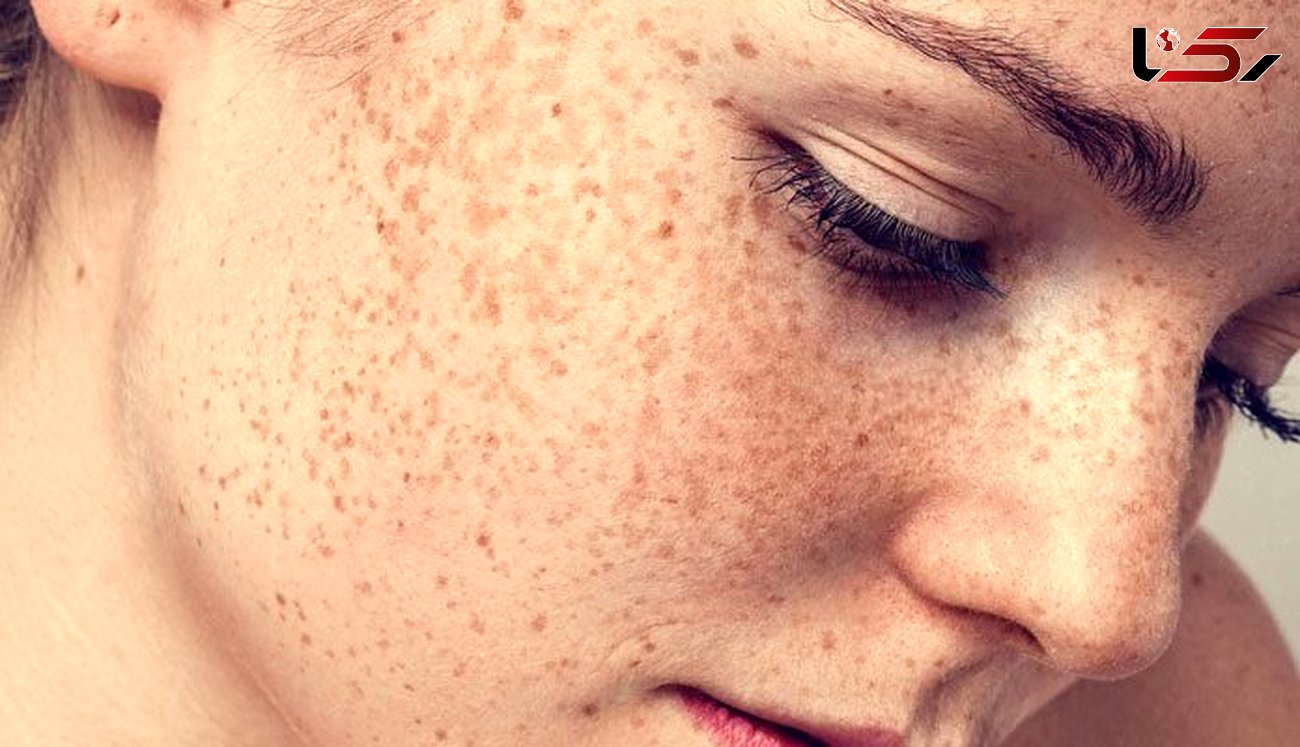ترفندهای گیاهی و موثر در درمان لک پوستی 