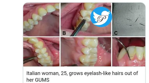 حادثه ای عجیب /  دندان های یک زن ایتالیایی مژه درآورد + عکس