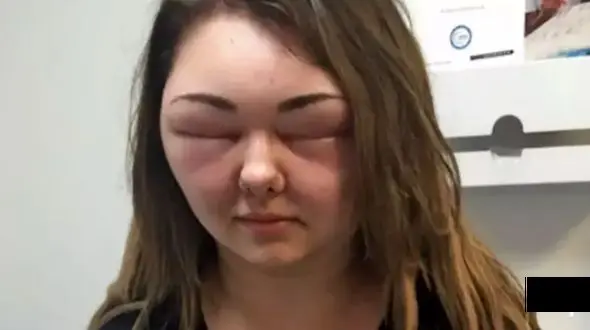 تورم وحشتناک صورت یک دختر 24 ساله به خاطر استفاده از رنگ مو 