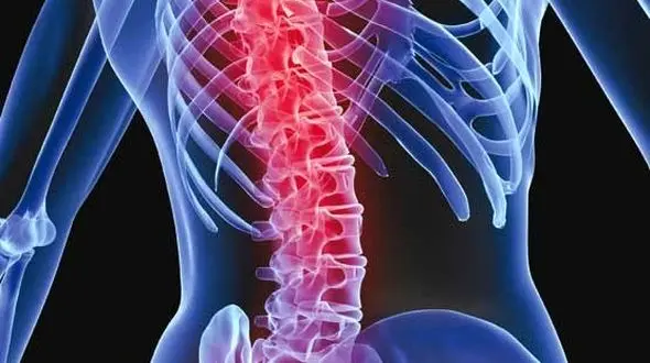 چرا انحراف ستون فقرات در دختران شایع تر است؟