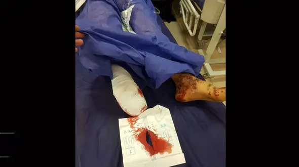 قطع عضو پسر ۱۳ ساله و مصدومیت ۱۷ نفر در چهارشنبه سوری استان سمنان