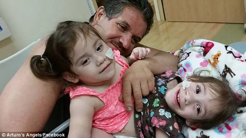 آغاز زندگی جدید برای دوقلوهای به هم چسبیده
