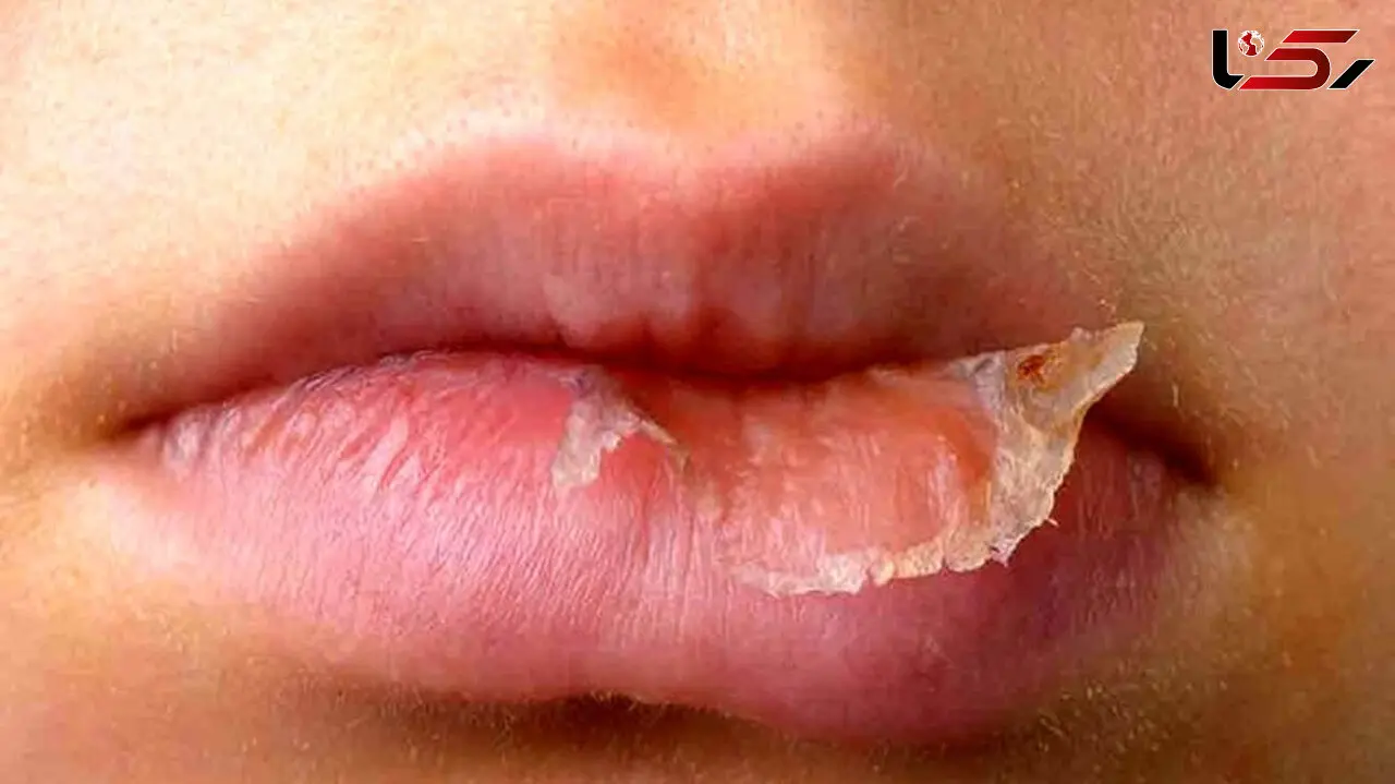 حقایق جالب درباره خشکی لب ها + فیلم