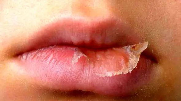 حقایق جالب درباره خشکی لب ها + فیلم