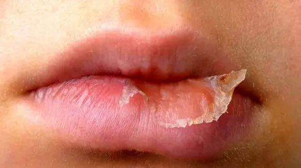 حقایق جالب درباره خشکی لب ها + فیلم