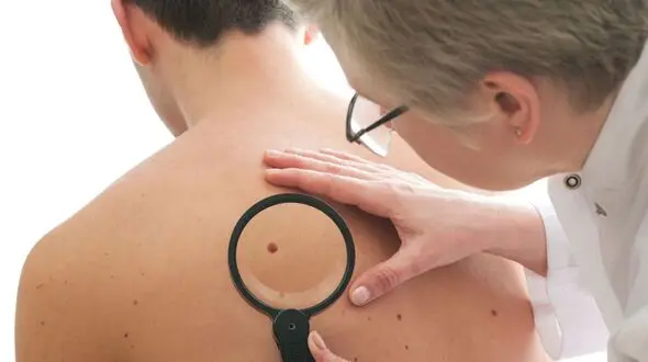 چرا خال ها سرطانی می شوند؟