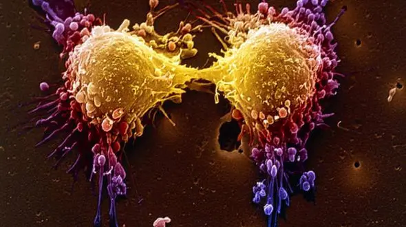  علت تشخیص دیرهنگام سرطان در کشور 