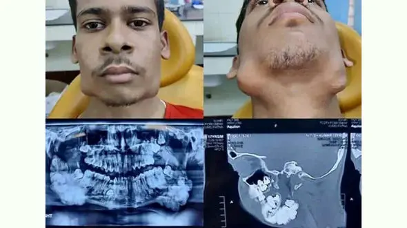 دهان این پسر نوجوان 82 دندان دارد + عکس 