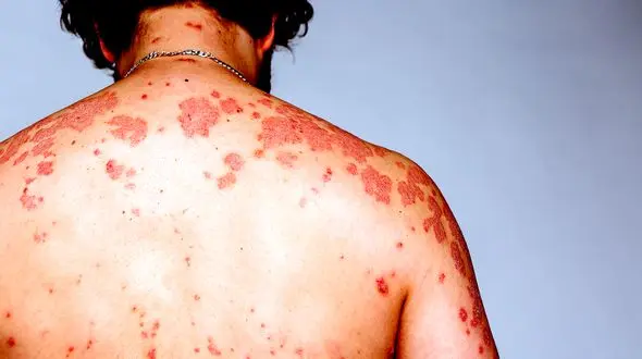 افزایش آمار ایدز در همجنسگرایان مرد/ایدزی ها بیشتر 20 تا 30 ساله اند/40درصد زنان مبتلا به HIV مشهد از همسرشان گرفته‌اند 