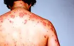 افزایش آمار ایدز در همجنسگرایان مرد/ایدزی ها بیشتر 20 تا 30 ساله اند/40درصد زنان مبتلا به HIV مشهد از همسرشان گرفته‌اند 