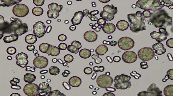 وجود کریستال در ادرار نشانه چه بیماری هایی است؟