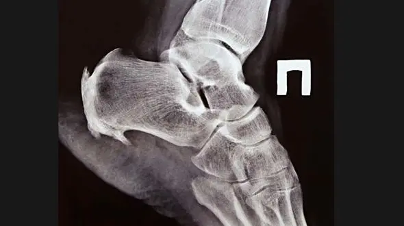 علت رشد استخوان اضافه چیست؟