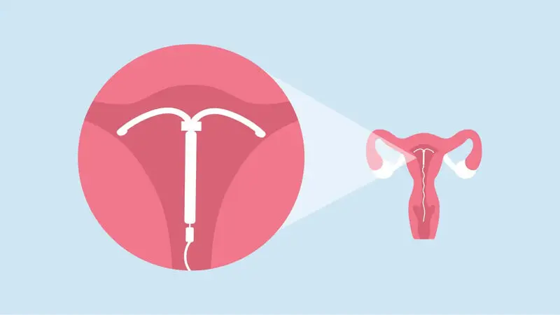 آی یو دی (IUD)