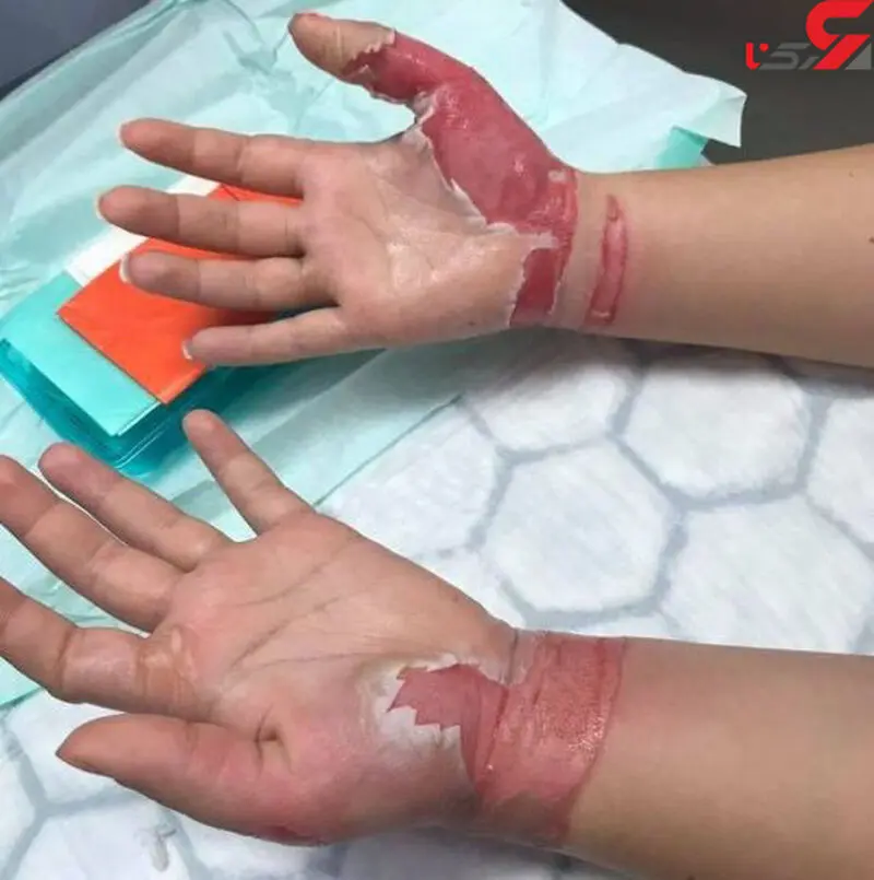 عکس سوختگی با آستون (2)