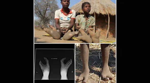 انسان های عجیب الخلقه با پای دو انگشتی + عکس 