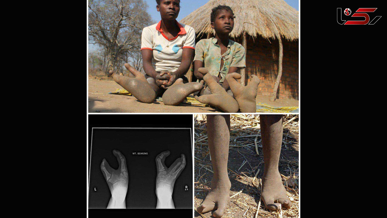 انسان های عجیب الخلقه با پای دو انگشتی + عکس 