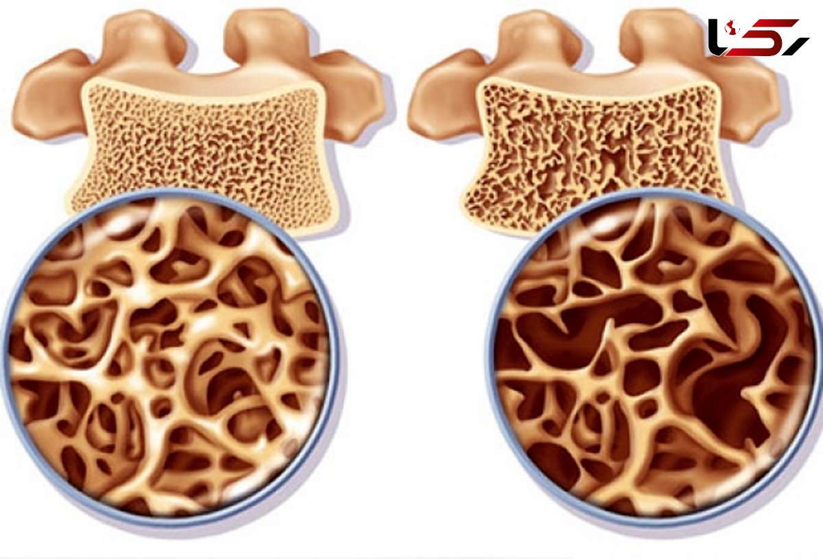 ۱۵ درصد ایرانی ها مبتلا به پوکی استخوان هستند