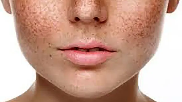 لک صورت چیست ؟ + فیلم