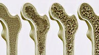 این افراد بیشتر در خطر پوکی استخوان هستند