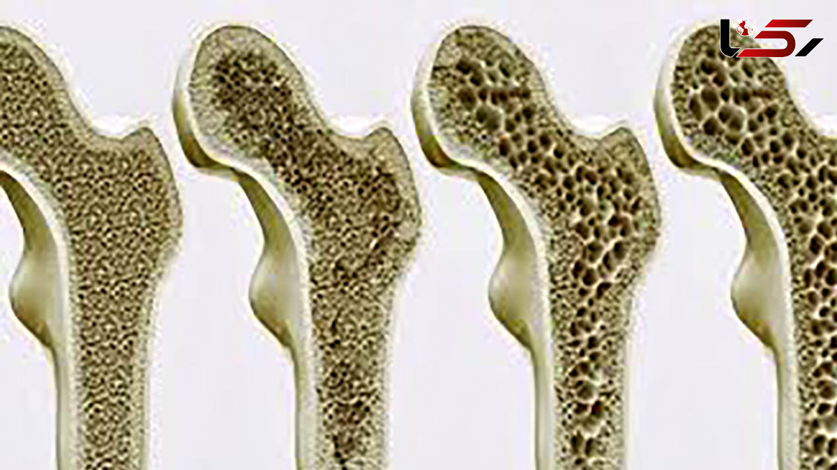 این افراد بیشتر در خطر پوکی استخوان هستند