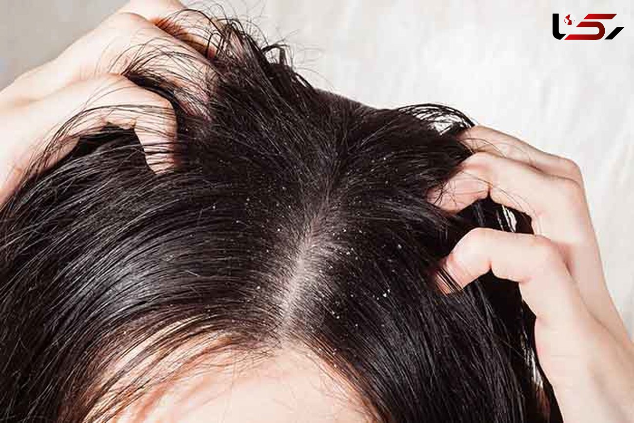 راهکارهای طلایی برای مقابله با موهای چرب