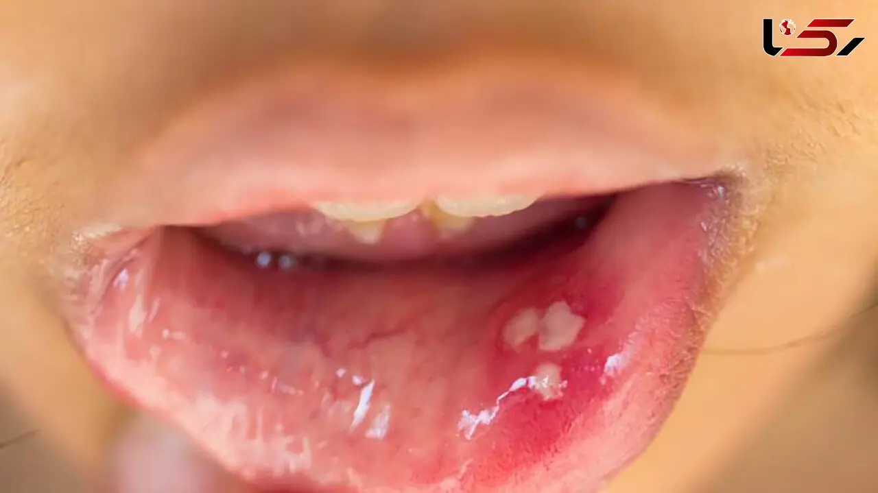 مشاهده HPV دهانی در افراد 13 تا 75 ساله! / فروش واکسن گارداسیل با قیمت نجومی بدون تضمین سلامت / تست های HPV دهانی تا 70 درصد نتیجه منفی کاذب دارد!