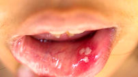 مشاهده HPV دهانی در افراد 13 تا 75 ساله! / فروش واکسن گارداسیل با قیمت نجومی بدون تضمین سلامت / تست های HPV دهانی تا 70 درصد نتیجه منفی کاذب دارد!