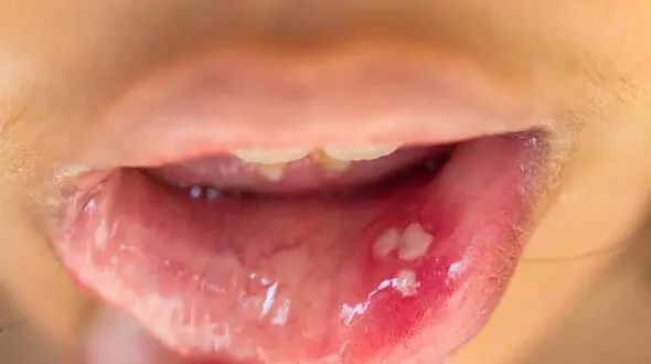 مشاهده HPV دهانی در افراد 13 تا 75 ساله! / فروش واکسن گارداسیل با قیمت نجومی بدون تضمین سلامت / تست های HPV دهانی تا 70 درصد نتیجه منفی کاذب دارد!