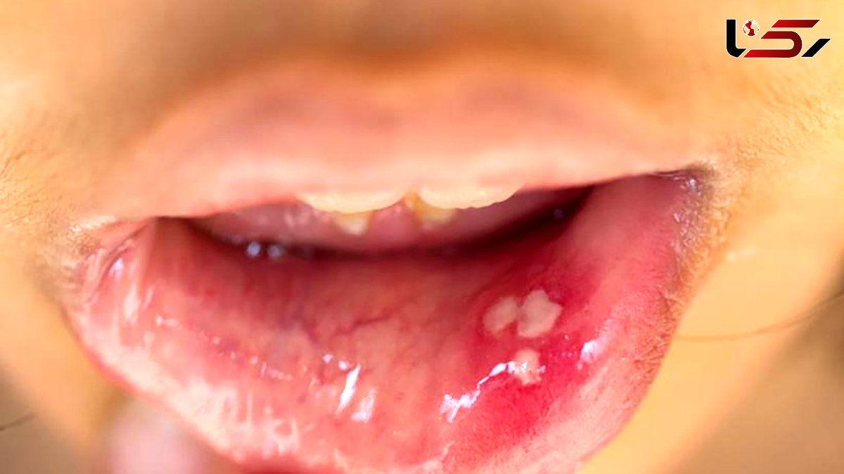  مشاهده HPV دهانی در افراد 13 تا 75 ساله! / فروش واکسن گارداسیل با قیمت نجومی بدون تضمین سلامت / تست های HPV دهانی تا 70 درصد نتیجه منفی کاذب دارد! 