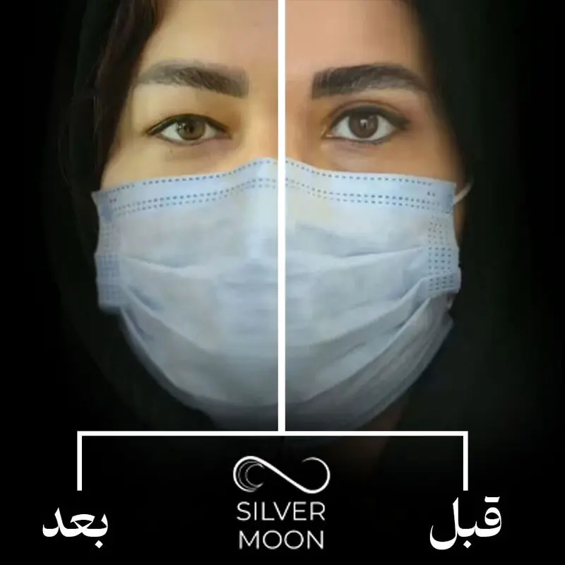 نمونه کار قبل و بعد بلفاروپلاستی افتادگی پلک