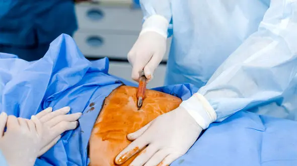 عمل ابدو چیست؟