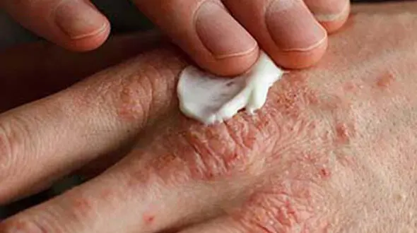مبارزه با اگزمای پوستی با باکتری های خوب