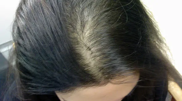 روش مقابله با کم پشتی مو