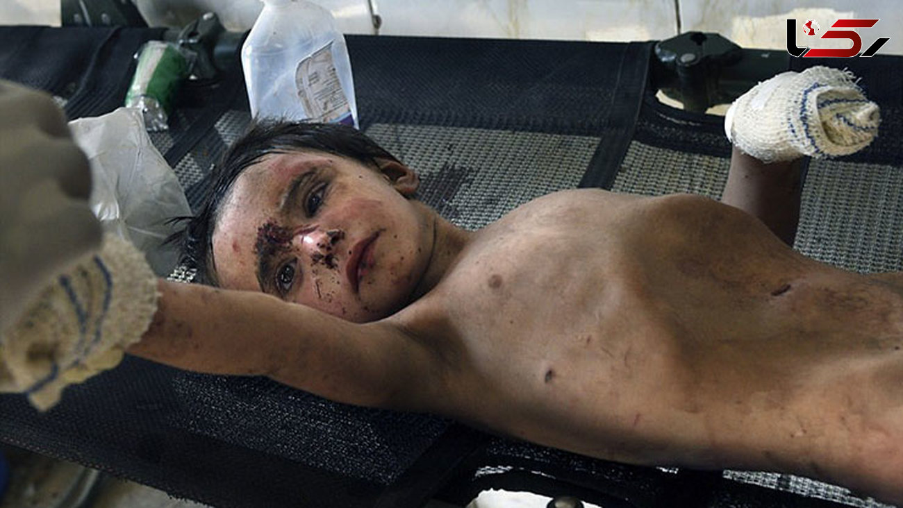 آثار دردناک جنایات داعش بر بدن کودکان موصل+ تصاویر 
