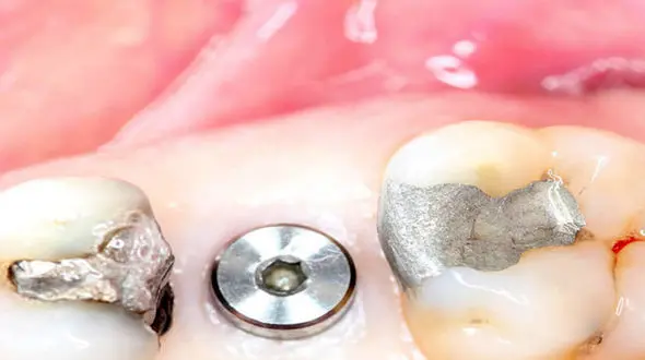 انقلابی در درمان دندان: خداحافظ ایمپلنت، سلام دندان آزمایشگاهی!