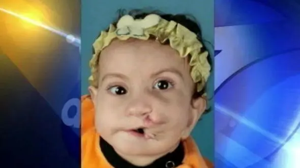 جراحی عجیب دختری که 2 دهان دارد! + عکس