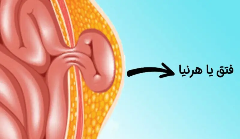 فتق هرنیا