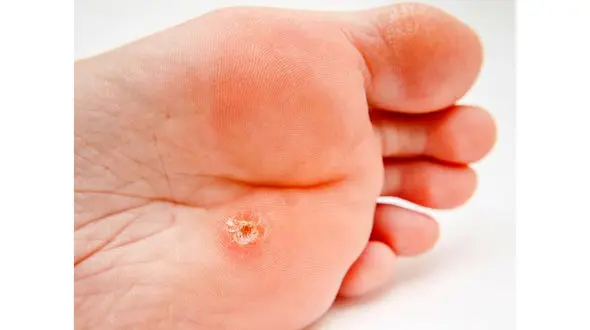 مهم‌ترین عامل ایجاد میخچه در پاها