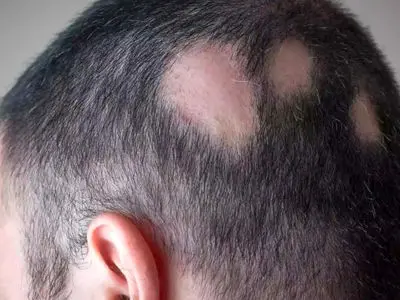 بررسی کامل رایج ترین بیماری های مو و روش های درمان