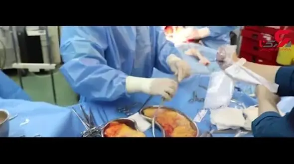 مقایسه قیمت عمل ۷۰۰ هزار دلاری پیوند کبد در آمریکا با ایران + فیلم 
