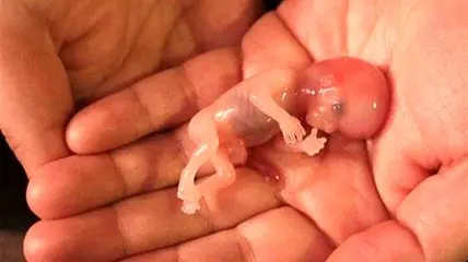 سقط جنین؛ زخمی عاطفی فراتر از یک اتفاق پزشکی