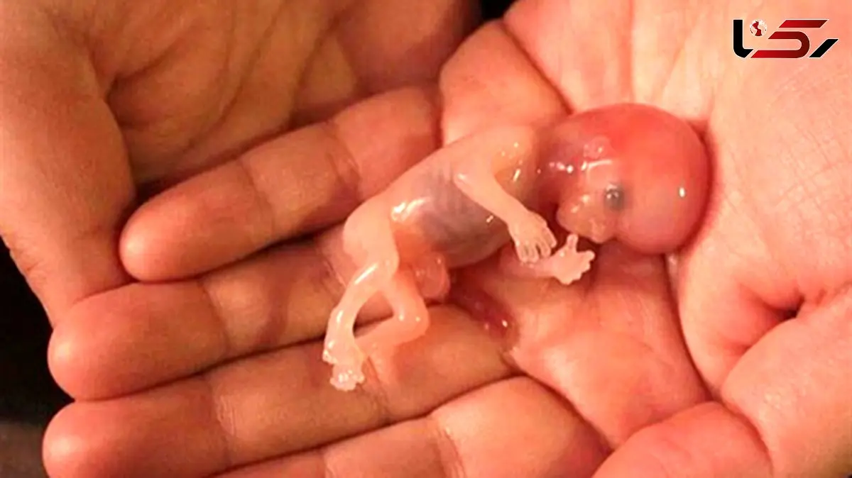 سقط جنین؛ زخمی عاطفی فراتر از یک اتفاق پزشکی