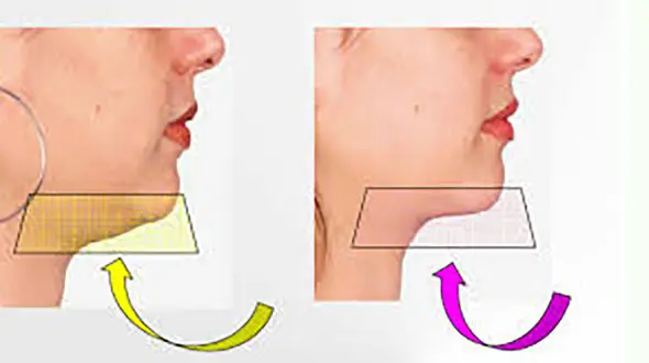 حرکات ورزشی برای رفع غبغب