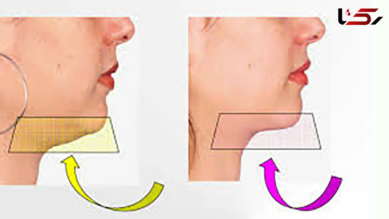 حرکات ورزشی برای رفع غبغب