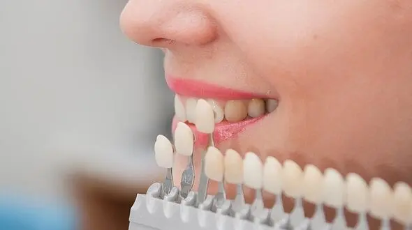 چه زمانی باید دندان ها را روکش کرد؟