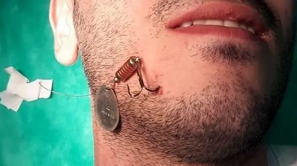 سوراخ شدن عجیب صورت پسر تهرانی به دست خود ! + تصاویر