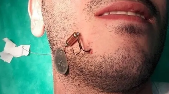 سوراخ شدن عجیب صورت پسر تهرانی به دست خود ! + تصاویر