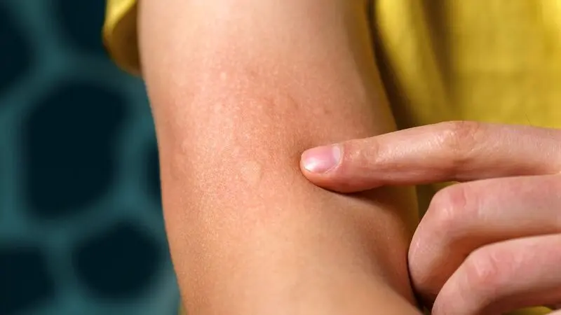 آلرژِی پوستی